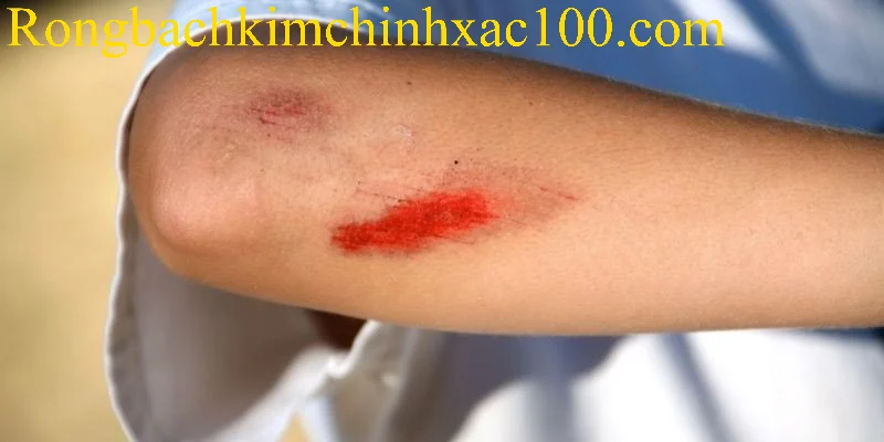 Mơ thấy bị thương dưới góc nhìn của tâm lý học